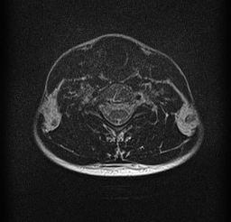 File:Cervical spondylodiscitis and calvarial hemangioma (Radiopaedia 64317-73104 Axial T2 15).jpg