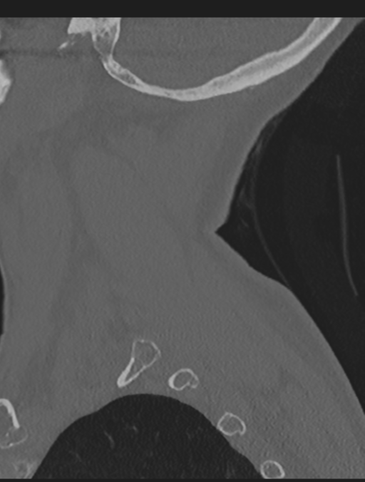 Cervical spondylolysis (Radiopaedia 49616-54811 Sagittal bone window 10).png