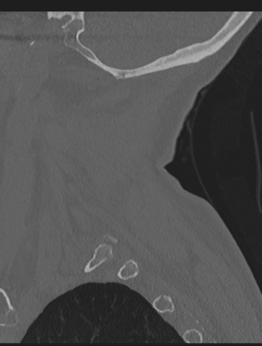 Cervical spondylolysis (Radiopaedia 49616-54811 Sagittal bone window 13).png