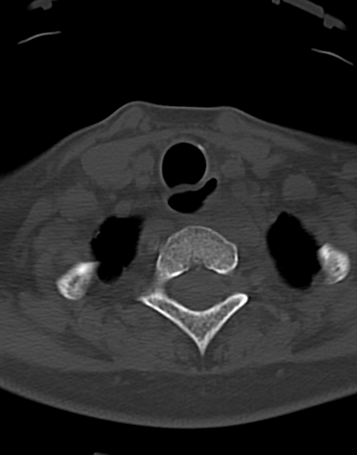 Cervical tuberculous spondylitis (Radiopaedia 39149-41365 Axial bone window 46).png