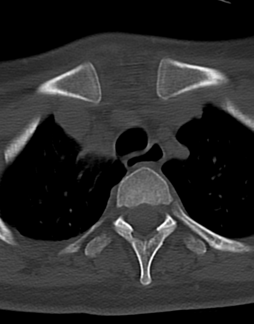 Cervical tuberculous spondylitis (Radiopaedia 39149-41365 Axial bone window 54).png