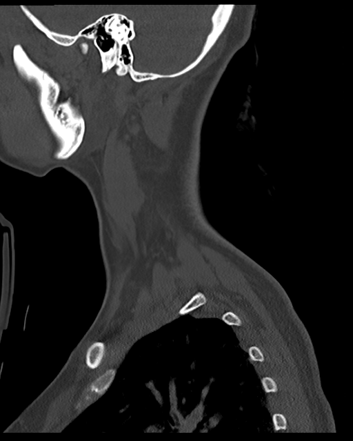 Cervical tuberculous spondylitis (Radiopaedia 39149-41365 Sagittal bone window 62).png