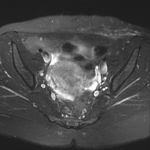 File:Cesarian section scar endometriosis (Radiopaedia 66520-75799 Axial T2 fat sat 10).jpg
