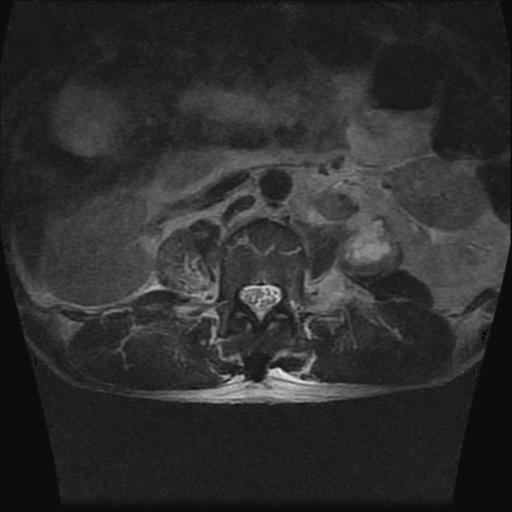 File:Chance type fracture (Radiopaedia 31020-31725 Axial T2 1).jpg