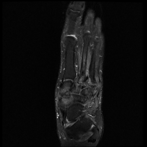 File:Charcot arthropathy (Radiopaedia 55056-61422 Axial PD fat sat 15).jpg