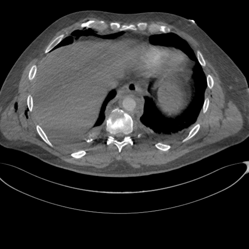Chest multitrauma - aortic injury (Radiopaedia 34708-36147 A 237).png