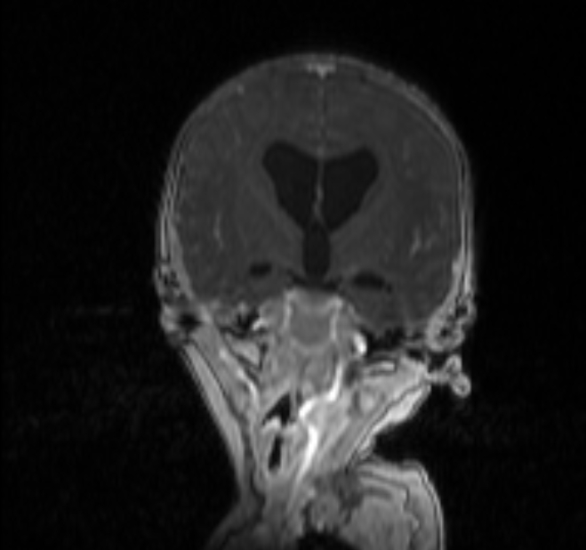 Chiari III malformation with occipital encephalocele (Radiopaedia 79446-92559 Coronal T1 C+ mpr 13).jpg