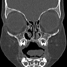 Choanal atresia (Radiopaedia 88525-105975 Coronal bone window 20).jpg