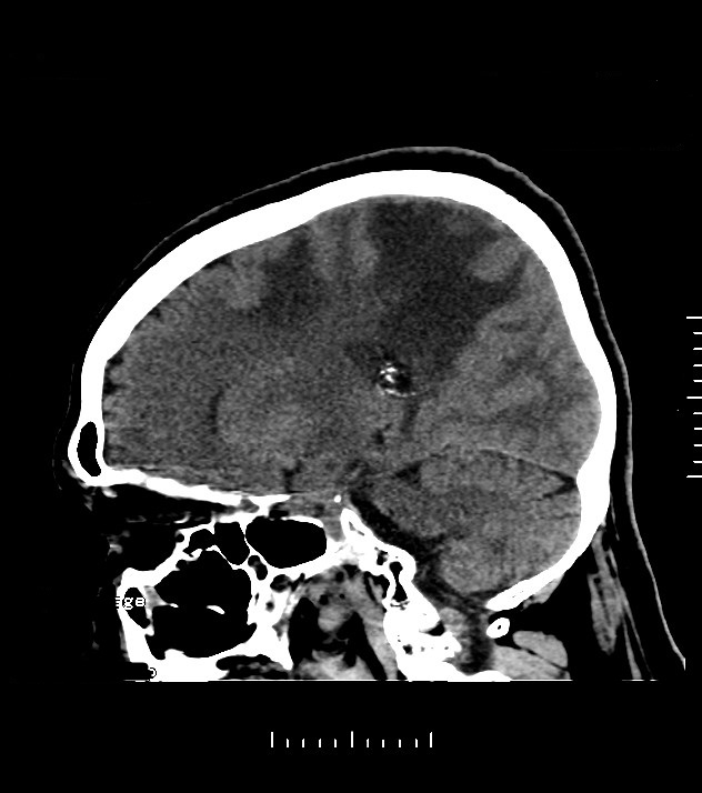 Cholangiocarcinoma with cerebral metastases (Radiopaedia 83519-98628 C 21).jpg