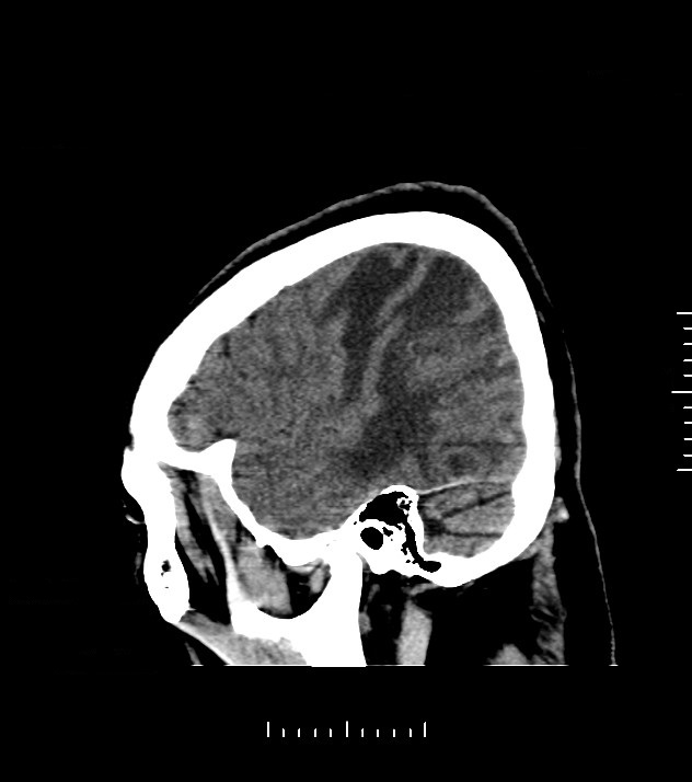 Cholangiocarcinoma with cerebral metastases (Radiopaedia 83519-98628 C 8).jpg