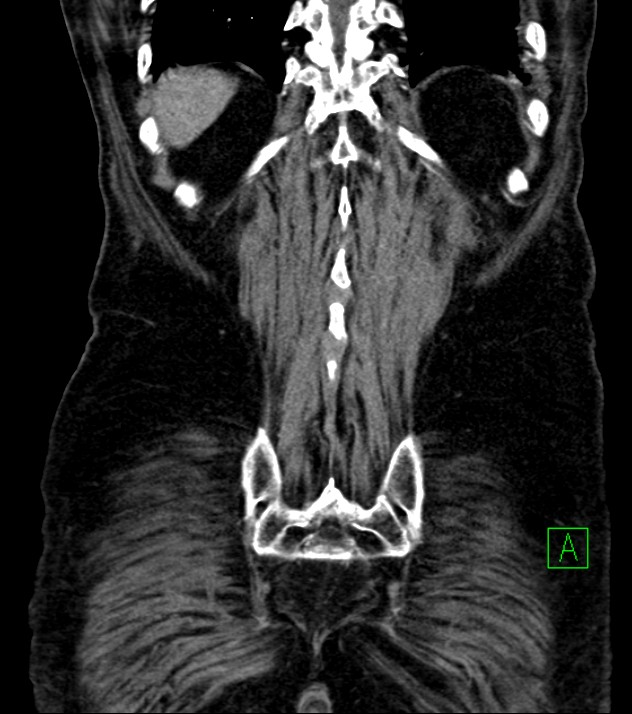 Cholangiocarcinoma with cerebral metastases (Radiopaedia 83519-98629 E 75).jpg