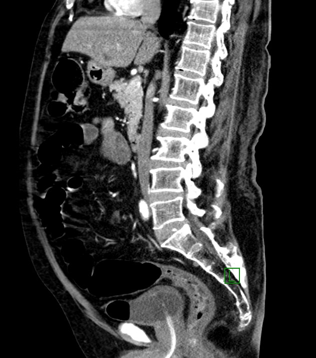 Cholangiocarcinoma with cerebral metastases (Radiopaedia 83519-98629 F 65).jpg