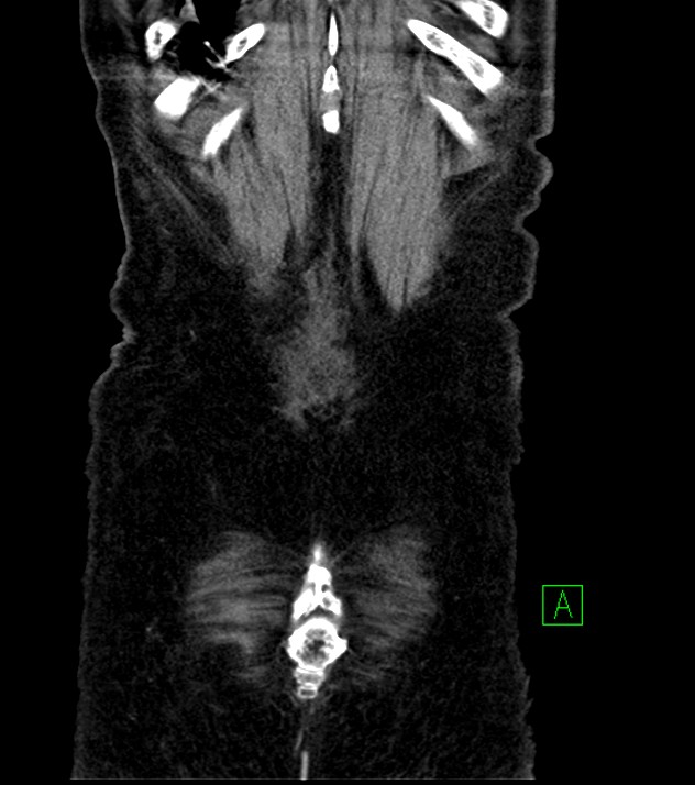 Cholangiocarcinoma with cerebral metastases (Radiopaedia 83519-98629 G 78).jpg
