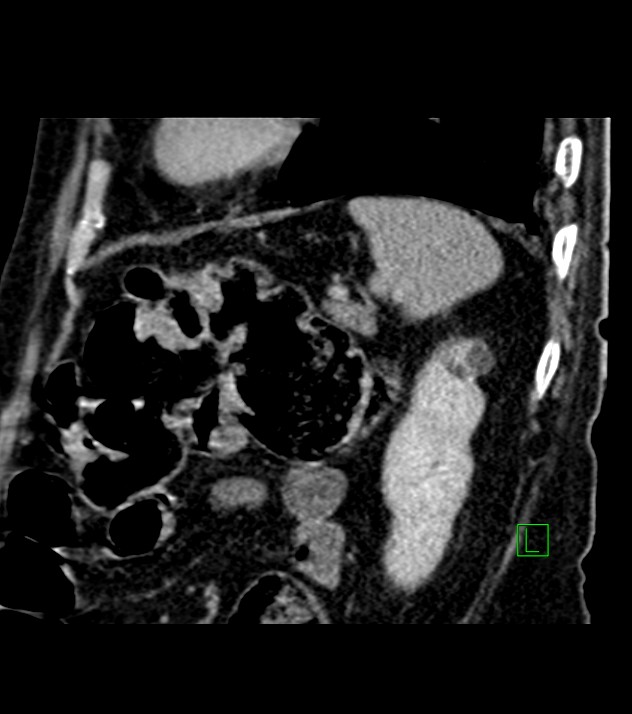 Cholangiocarcinoma with cerebral metastases (Radiopaedia 83519-98629 Sagittal C+ delayed 27).jpg