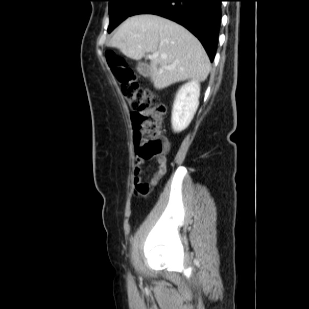 Choledocholithiasis on CT and MRI (Radiopaedia 24825-25087 D 18).jpg