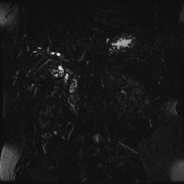 Choledocholithiasis on CT and MRI (Radiopaedia 24825-25088 Coronal T2 24).jpg