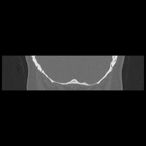 Cholesteatoma (Radiopaedia 84946-100455 Coronal bone window 136).jpg