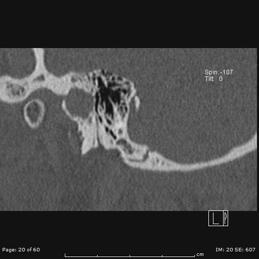 Cholesteatoma - external auditory canal (Radiopaedia 88452-105096 Sagittal bone window 20).jpg
