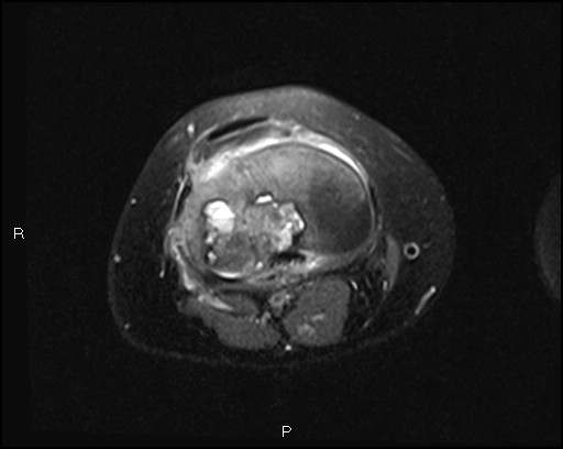 File:Chondroblastoma (Radiopaedia 62721-71031 Axial PD fat sat 21).jpg