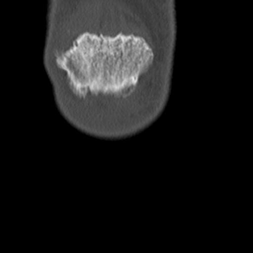 Chondrocalcinosis (Radiopaedia 16275-15955 Coronal bone window 4).jpg