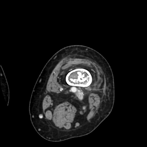 Chondrosarcoma - femur (Radiopaedia 64187-72954 Axial with contrast 19).jpg