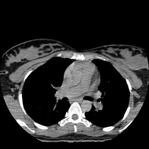 Choriocarcinoma of ovary with cerebral and pulmonary metastases (Radiopaedia 25983-26119 Axial non-contrast 129).jpg