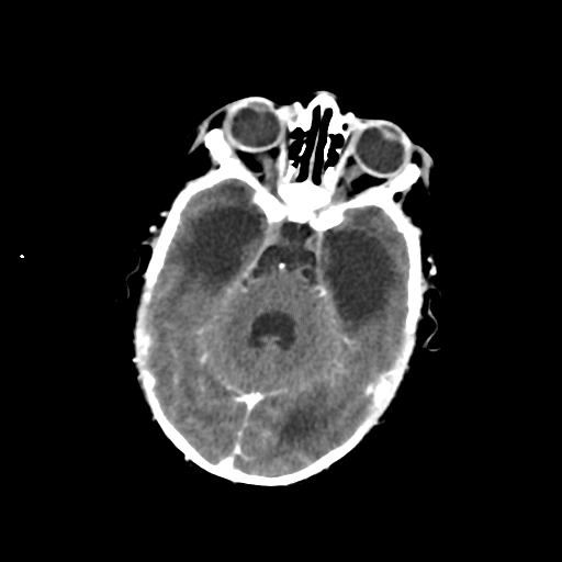 Choroid plexus papilloma (Radiopaedia 63946-72698 Axial with contrast 18).jpg
