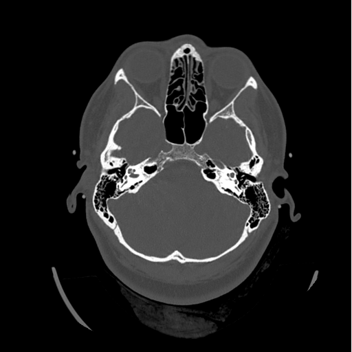 Choroid plexus papilloma extending into the cerebellopontine angle cistern (Radiopaedia 85941-101833 Axial bone window 27).png