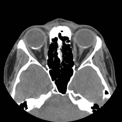 File:Choroidal osteoma (bilateral) (Radiopaedia 23284-23343 B 1).jpg