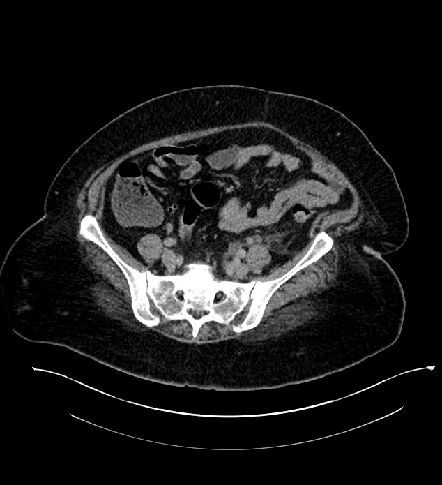 Chromophobe renal cell carcinoma (Radiopaedia 84239-99519 E 116).jpg