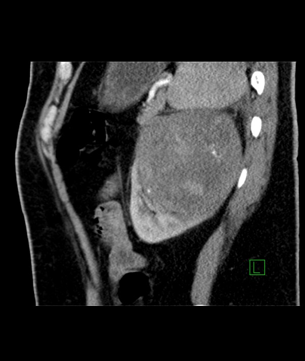 Chromophobe renal cell carcinoma (Radiopaedia 84255-99542 E 14).jpg