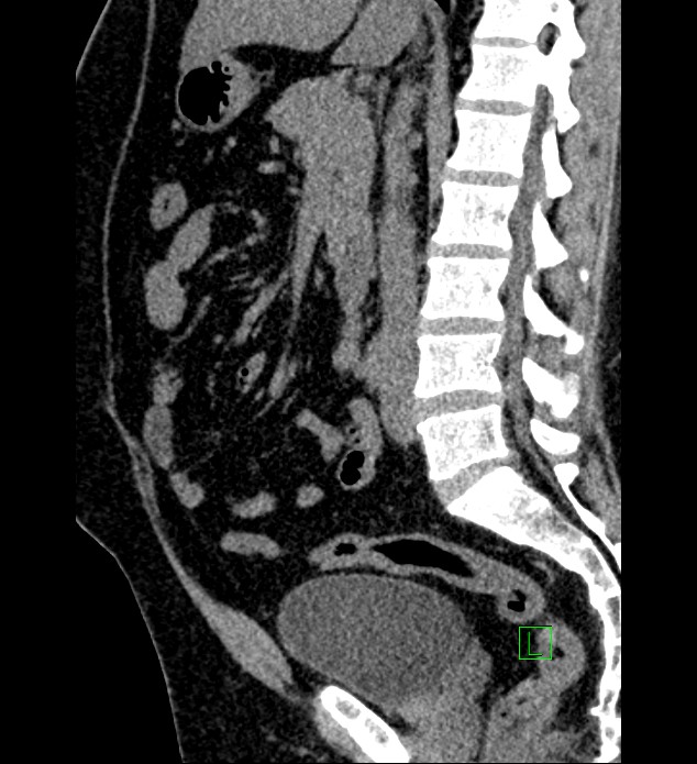Chromophobe renal cell carcinoma (Radiopaedia 84286-99573 C 93).jpg