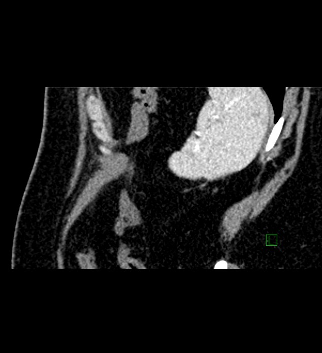Chromophobe renal cell carcinoma (Radiopaedia 84286-99573 F 18).jpg