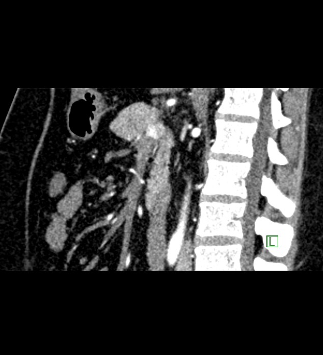 Chromophobe renal cell carcinoma (Radiopaedia 84286-99573 F 85).jpg