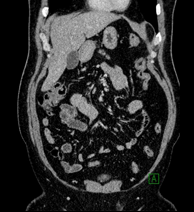 Chromophobe renal cell carcinoma (Radiopaedia 84286-99573 H 54).jpg