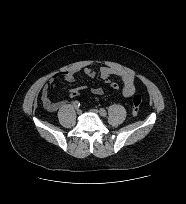 Chromophobe renal cell carcinoma (Radiopaedia 84337-99693 Axial non-contrast 107).jpg