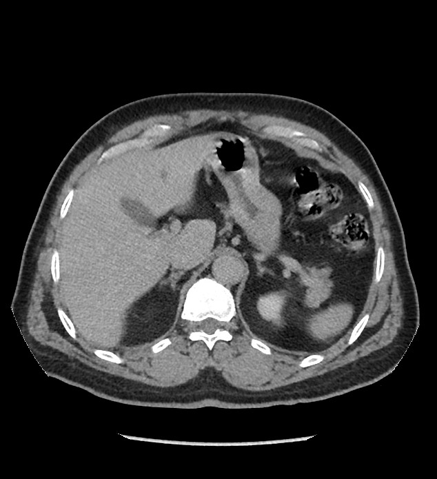 Chromophobe renal cell carcinoma (Radiopaedia 86879-103083 D 31).jpg