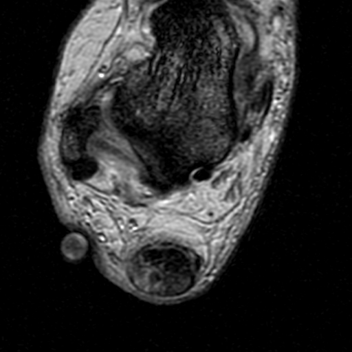 File:Chronic Achilles tendon rupture (Radiopaedia 15262-15100 Axial Gradient Echo 16).jpg