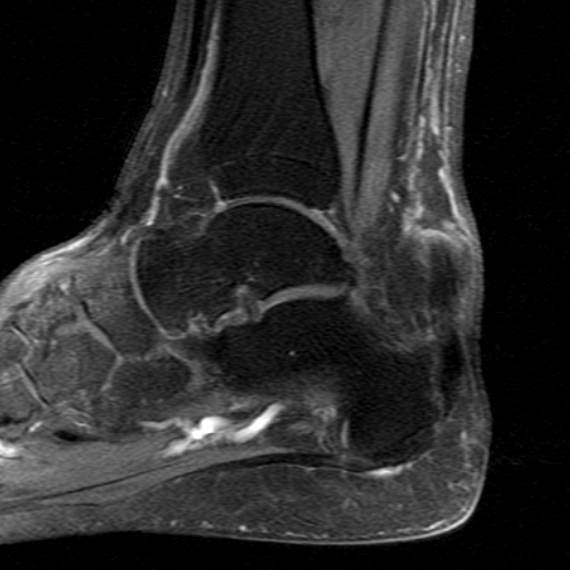 File:Chronic Achilles tendon rupture (Radiopaedia 15262-15100 C 8).jpg