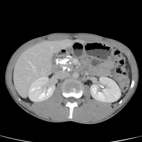 File:Chronic calcific pancreatitis (Radiopaedia 56280-62953 C 20).jpg