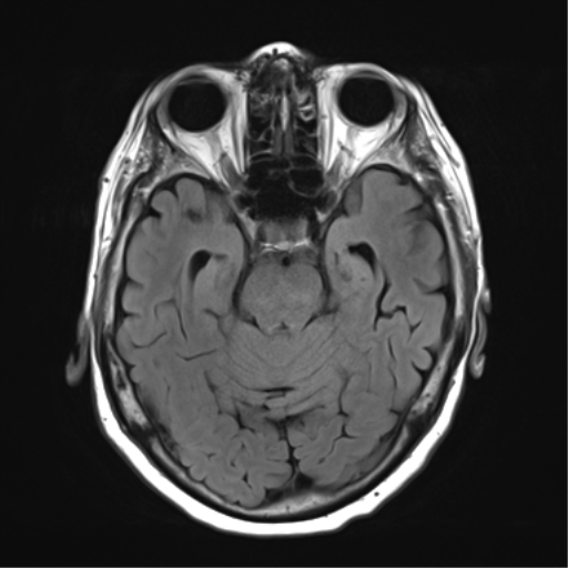 File:Chronic hypertensive encephalopathy (Radiopaedia 39993-42482 Axial FLAIR 9).png