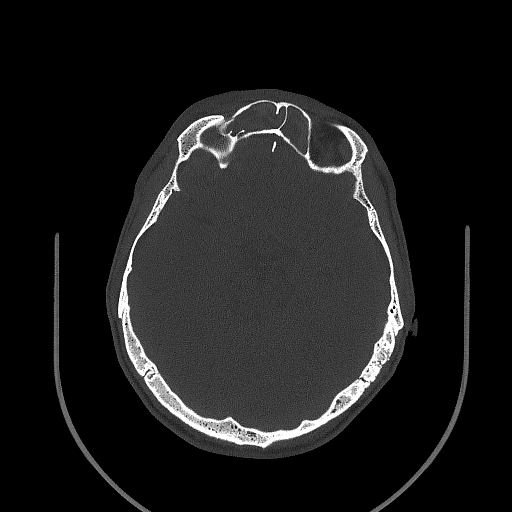 Chronic invasive fungal sinusitis (Radiopaedia 50342-55710 Axial bone window 108).jpg