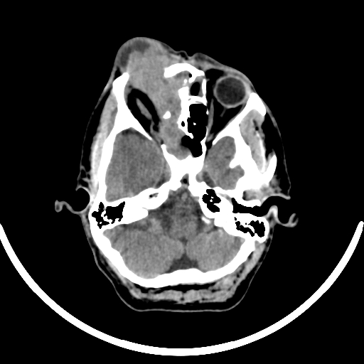 Chronic invasive fungal sinusitis with intraorbital and intracranial extension (Radiopaedia 56387-63046 Axial non-contrast 125).jpg