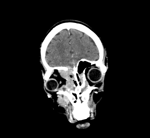 Chronic invasive fungal sinusitis with intraorbital and intracranial extension (Radiopaedia 56387-63046 C 78).jpg