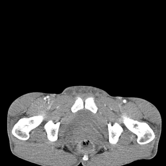 Chronic large bowel pseudo-obstruction (Radiopaedia 43181-46492 A 162).jpg