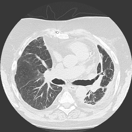 Chronic lung allograft dysfunction - restrictive form (Radiopaedia 60595-68316 Axial lung window 31).jpg