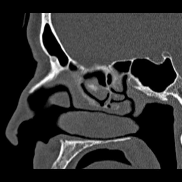 Chronic maxillary sinusitis (Radiopaedia 27879-28116 Sagittal bone window 24).jpg