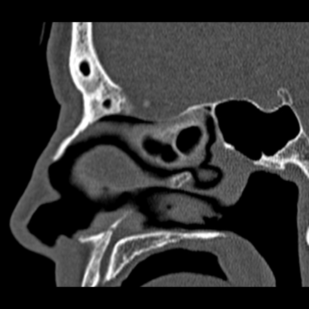 Chronic maxillary sinusitis (Radiopaedia 27879-28116 Sagittal bone window 29).jpg