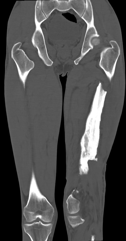 Chronic osteomyelitis (with sequestrum) (Radiopaedia 74813-85822 Coronal non-contrast 34).jpg