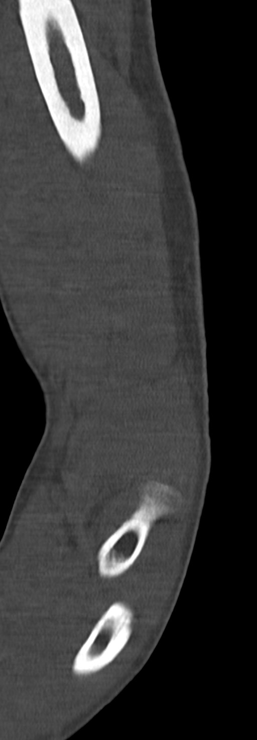 Chronic osteomyelitis of the distal humerus (Radiopaedia 78351-90971 Sagittal bone window 39).jpg